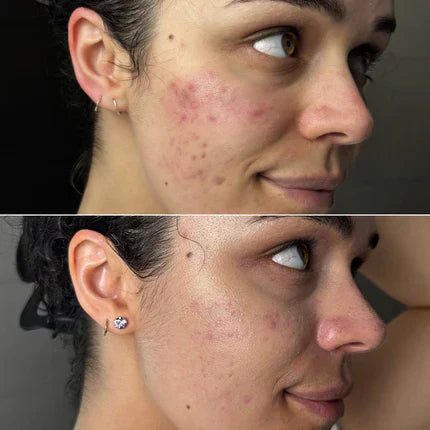 LumiGlow Pro LED Therapy - Skin transformation results